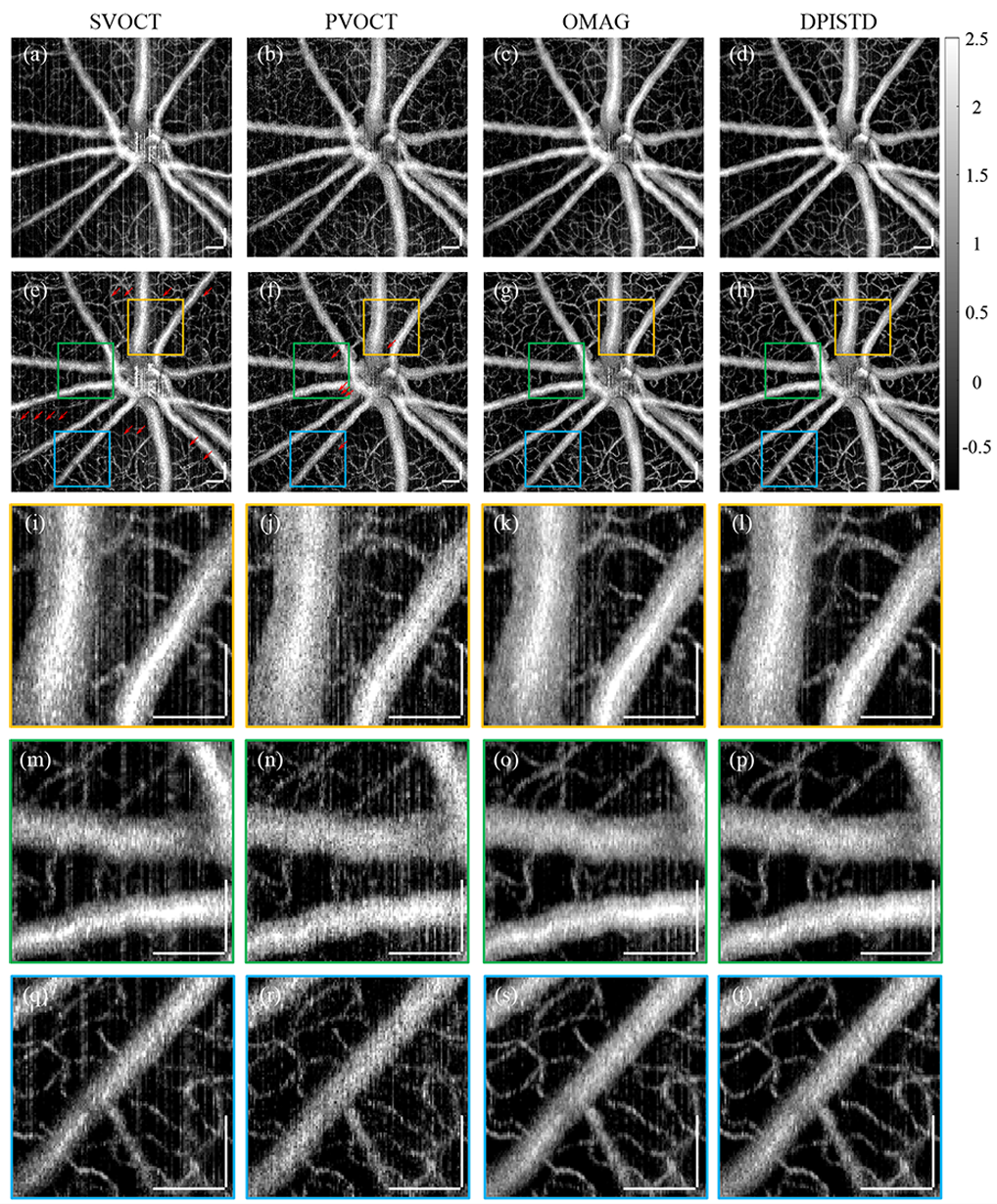 融合差分相位与强度图像提升视网膜OCTA活体成像质量——《Optics Letters》论文